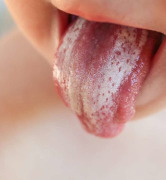 manchas en la lengua