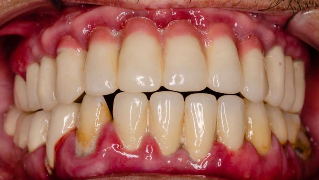 periodontitis encias moradas