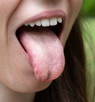 granos en la lengua