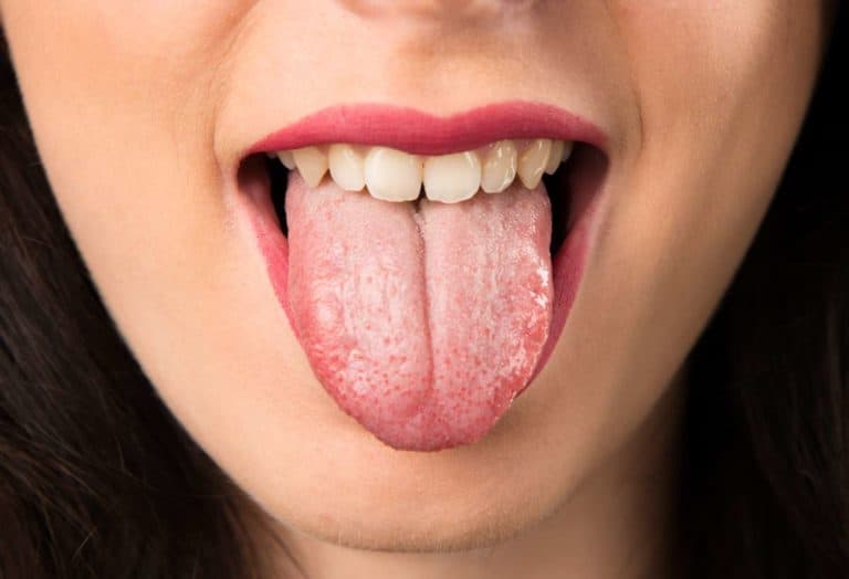 Lengua Amarilla Causas Y Tratamientos BUCAL ORG