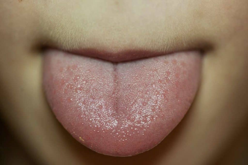 sintomas granos en la lengua