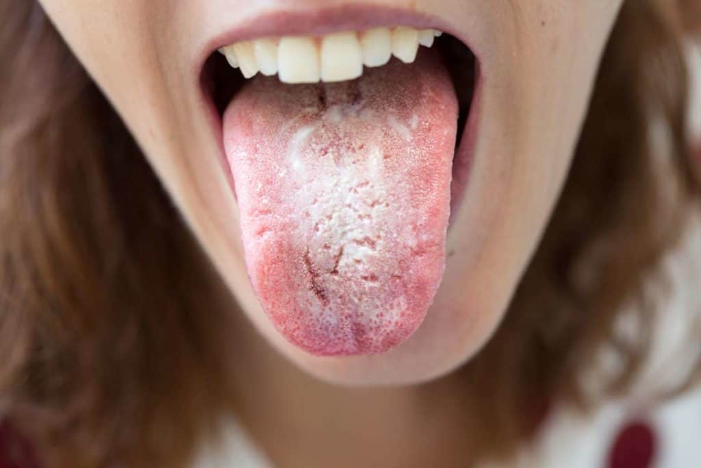 causas lengua blanca