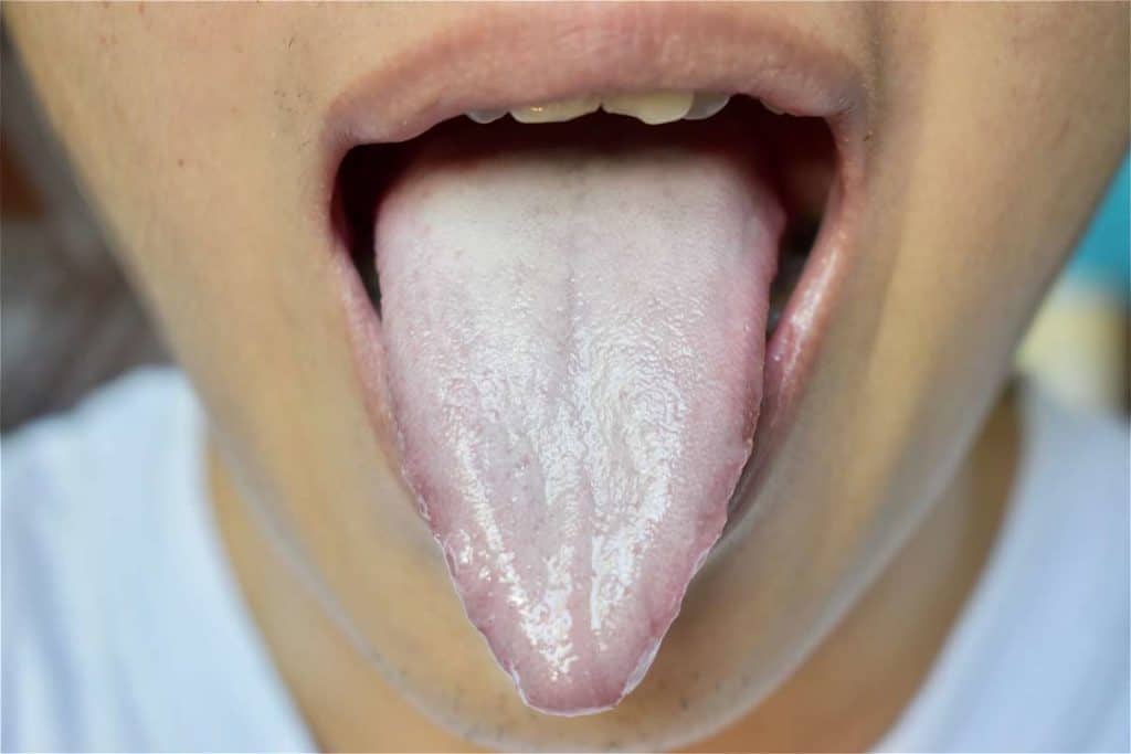 remedios lengua blanca