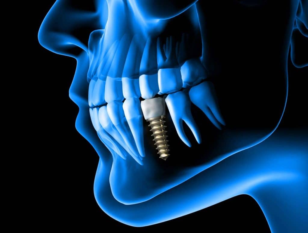 Implantes Dentales ventajas