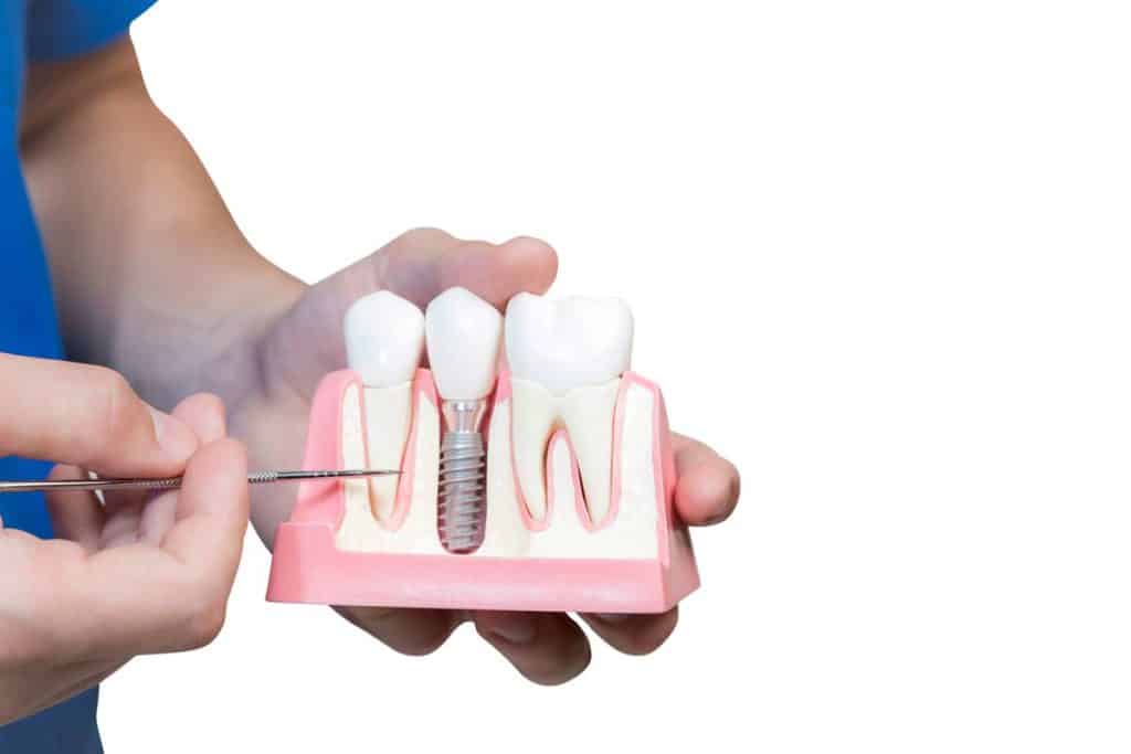 partes de los implantes dentales
