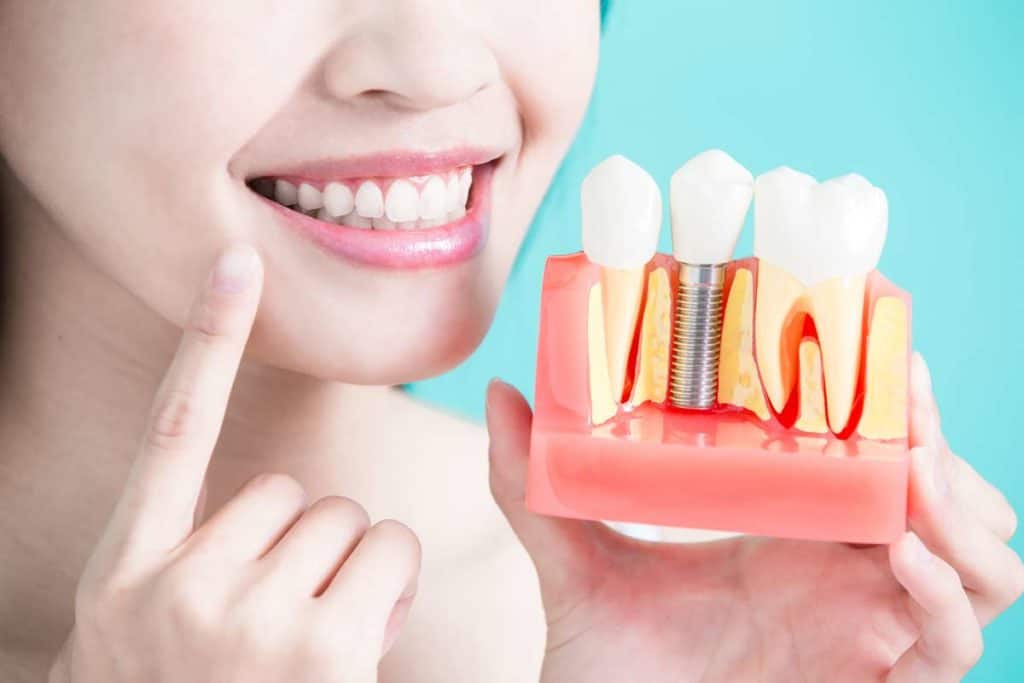 tipos de Implantes Dentales